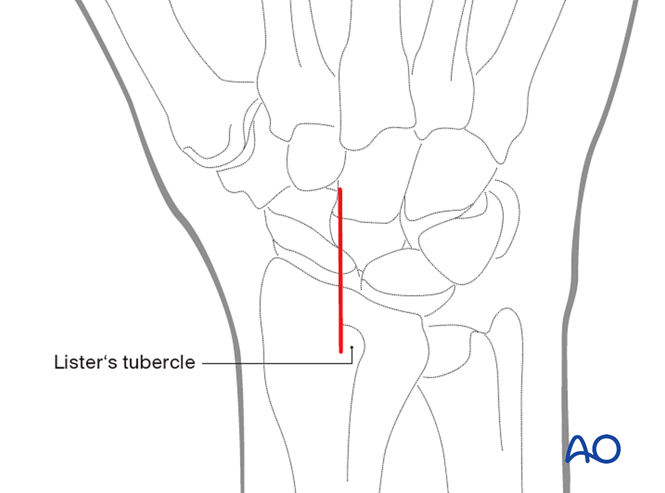 Dorsal approach to the scaphoid