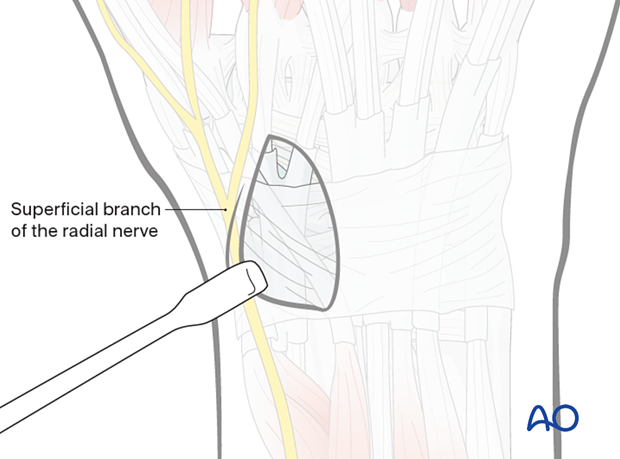 Identifying the radial nerve during dorsal approach to the scaphoid