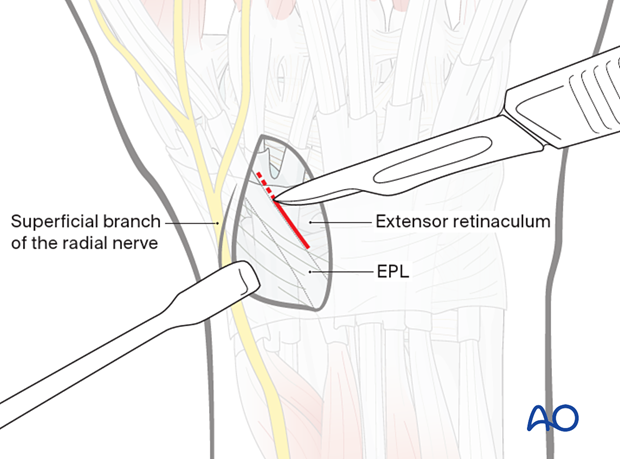 Incision of the retinaculum during dorsal approach to the scaphoid