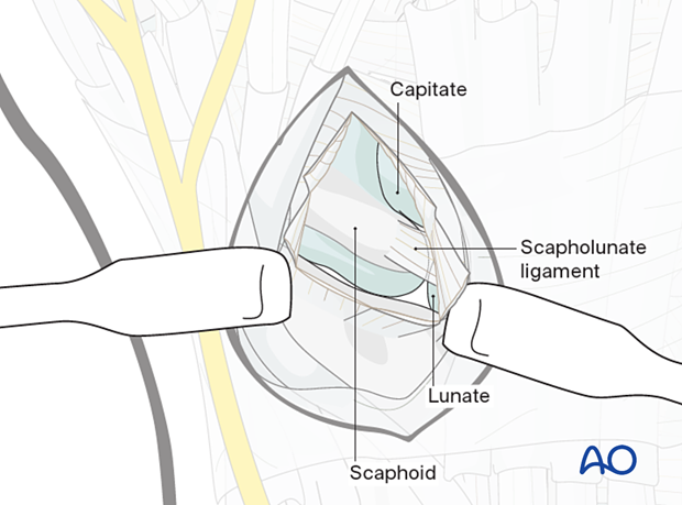 approach to the le fort i level of the midface in cleft lip and palate patients