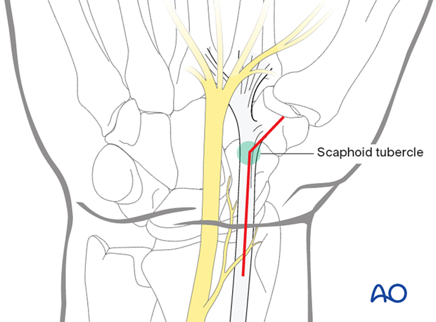 Palmar approach to the scaphoid