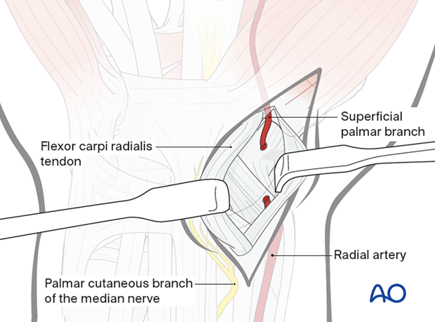 Palmar approach to the scaphoid – Opening the FCR sheath