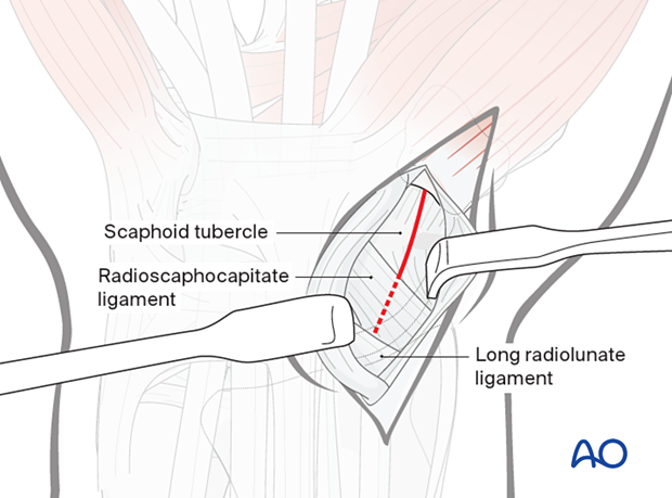 Palmar approach to the scaphoid