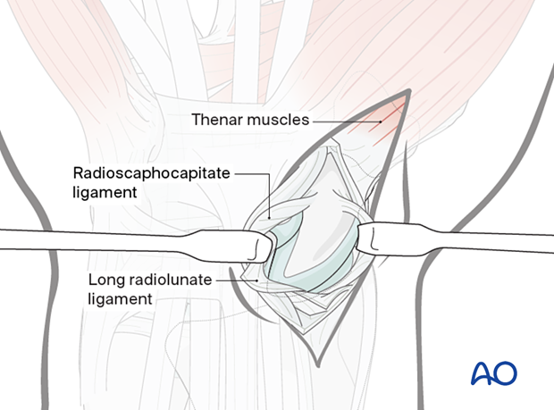 Palmar approach to the scaphoid – Retracting the divided radioscaphocapitate ligament to expose the scaphoid