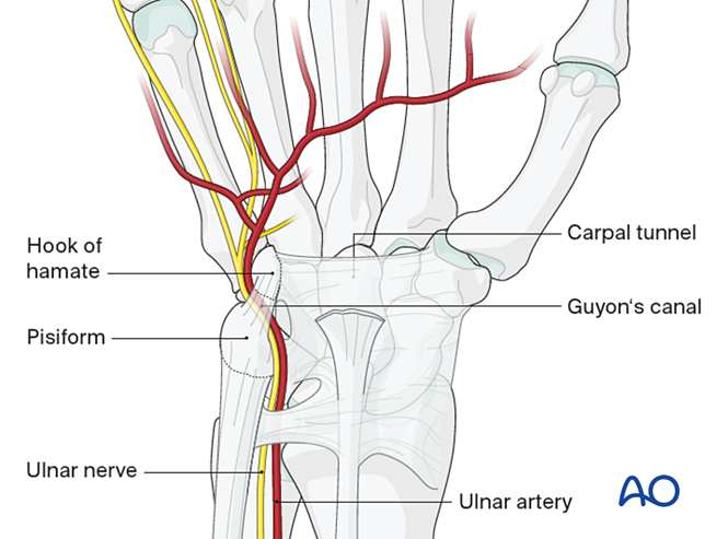 Ulnar approach to the hamate hook