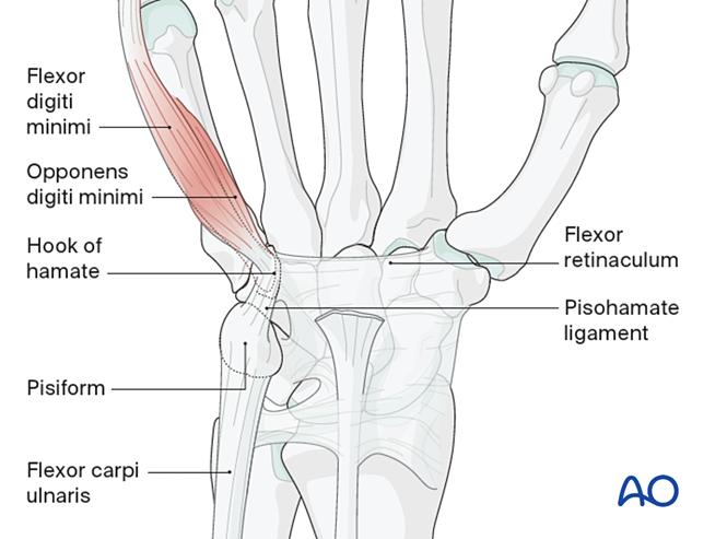 Ulnar approach to the hamate hook