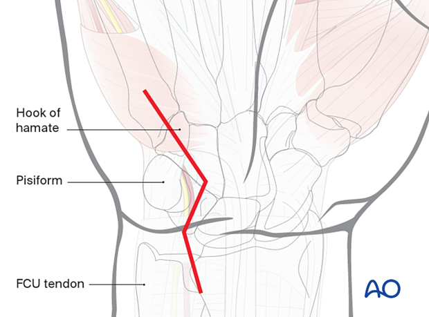 Ulnar approach to the hamate hook