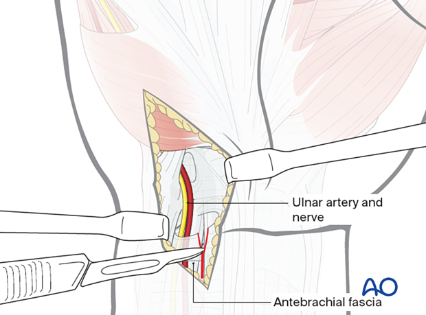 Deep dissection during ulnar approach to the hamate hook