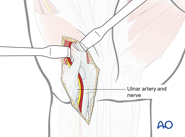 Retracting the ulnar artery during the ulnar approach to the hamate hook