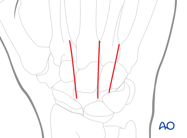 Incisions for a dorsal approach to the CMC joints