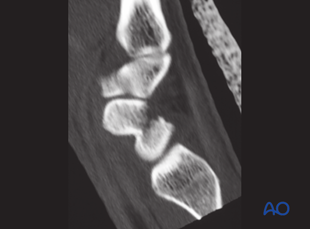 Scaphoid fracture – CT scan