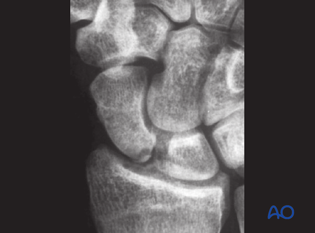 Scaphoid fracture – PA x-ray showing only a tiny fracture of the proximal pole of the scaphoid
