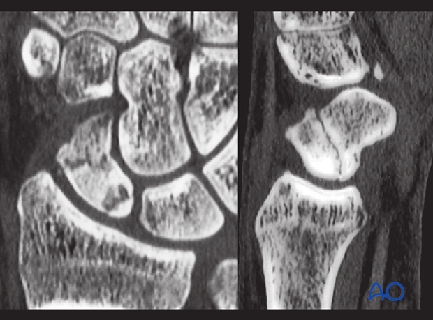 Scaphoid fracture – CT scans in the longitudinal axis of the scaphoid show the fracture at the proximal pole