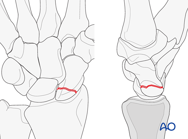 Proximal pole fracture of the scaphoid