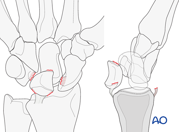 Lunate dislocation