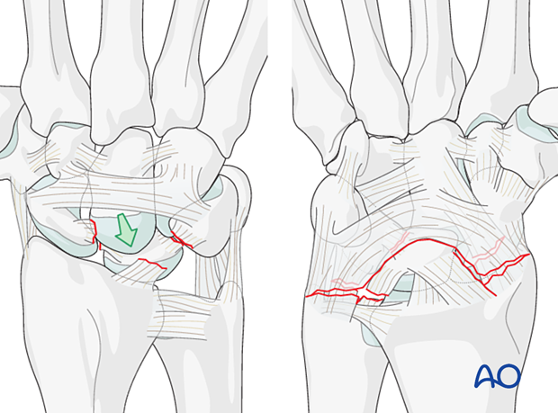 Complete dislocation of the lunate