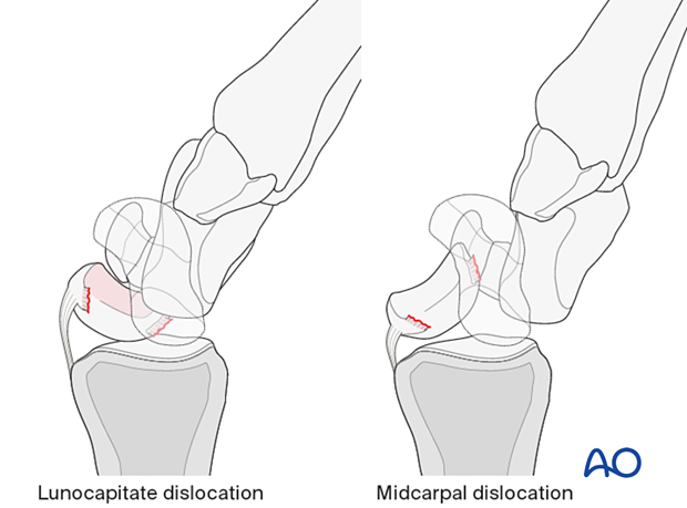 Lunocapitate dislocation and midcarpal dislocation