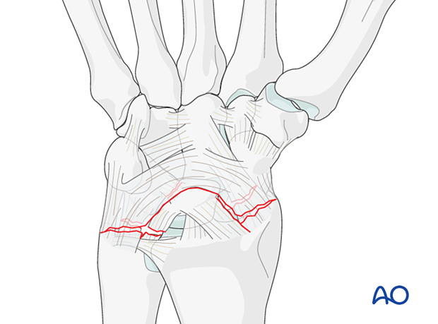 Lunocapitate dislocation and midcarpal dislocation - injury pattern of perilunate dislocations