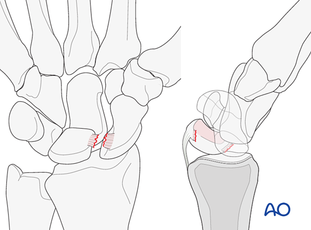 Lunocapitate dislocation