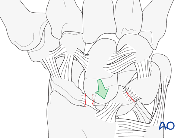 Midcarpal dislocation