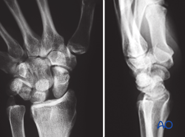 In the AP view, a scapholunate gap is visible. In the lateral view, the tilted lunate orientation indicates a dorsal intercalated segment instability (DISI).