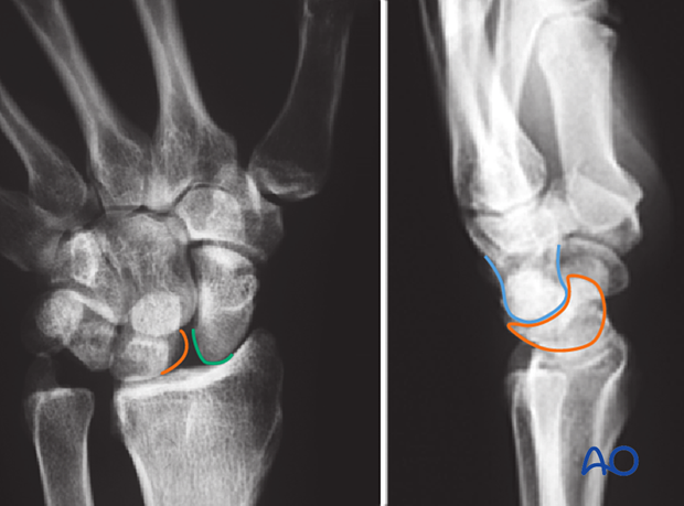 The lines show the proximal scaphoid (green), lunate (orange), and capitate (blue)