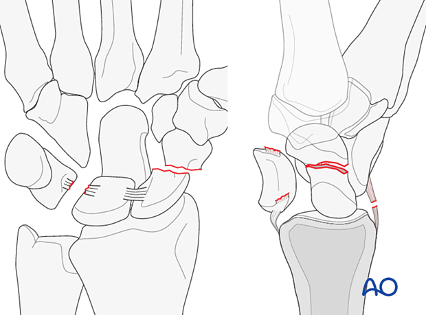 Greater arc injuries and perilunate fracture-dislocations