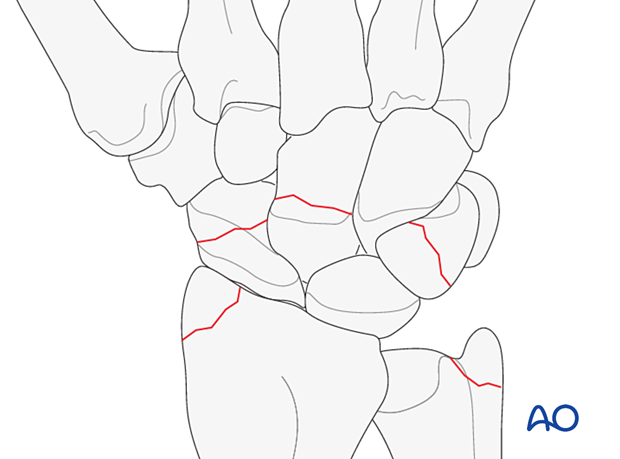 Greater arc injuries and perilunate fracture-dislocations