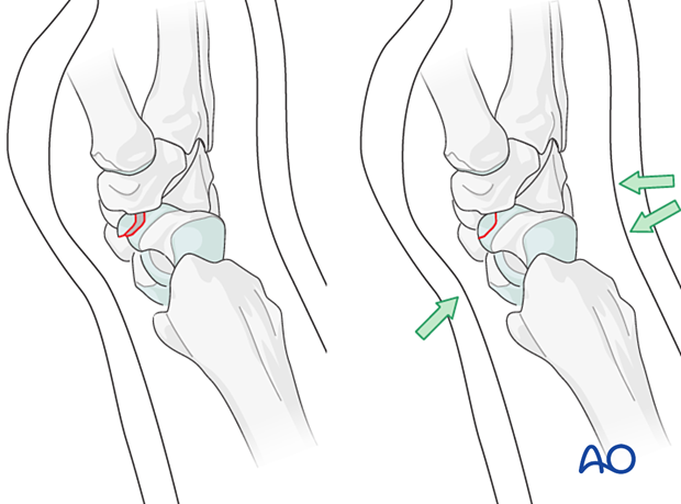 Closed reduction of a scaphoid fracture with cast molding