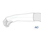 A below-elbow cast, with the wrist neutral to slightly flexed.