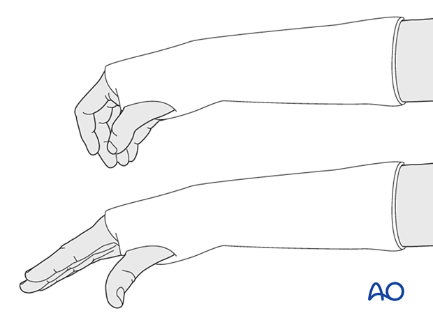 Below-elbow cast allowing for complete movement of the metacarpophalangeal joints of the fingers and the interphalangeal joint of the thumb