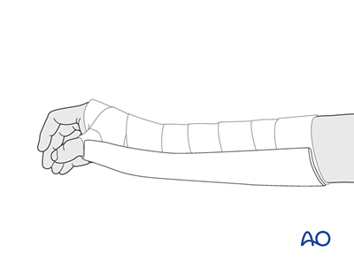 Closed reduction - Splinting (preliminary treatment) for Lunocapitate ...