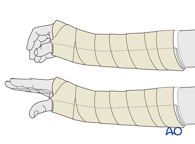 Palmar splint allowing for complete movement of the metacarpophalangeal joints of the fingers and the interphalangeal joint of the thumb