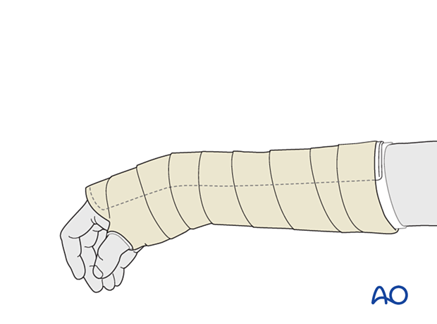 Dorsal splinting of the wrist with slight flexion