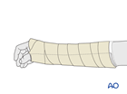 The wrist is immobilized in a palmar plaster splint in the neutral position.