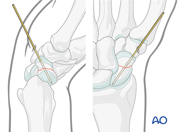 Scaphoid waist fracture - percutaneous screw fixation through a palmar approach: position of guide wire