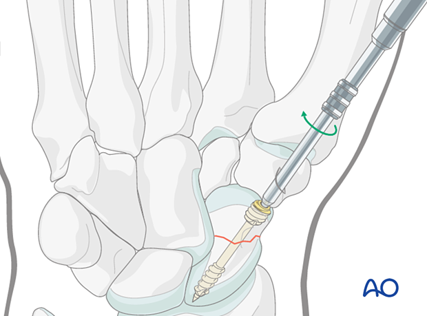 Scaphoid waist fracture – insertion of cannulated headless compression screw