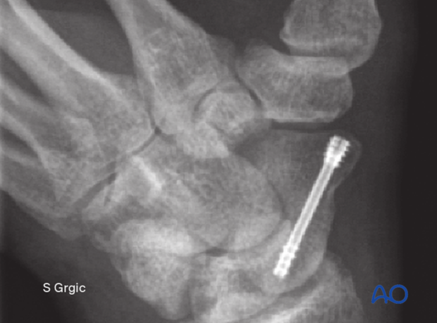 Percutaneous screw fixation through a palmar approach for Scaphoid ...