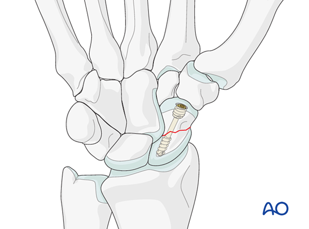 Scaphoid waist fracture fixed with a headless compression screw used in a retrograde fashion through a palmar approach