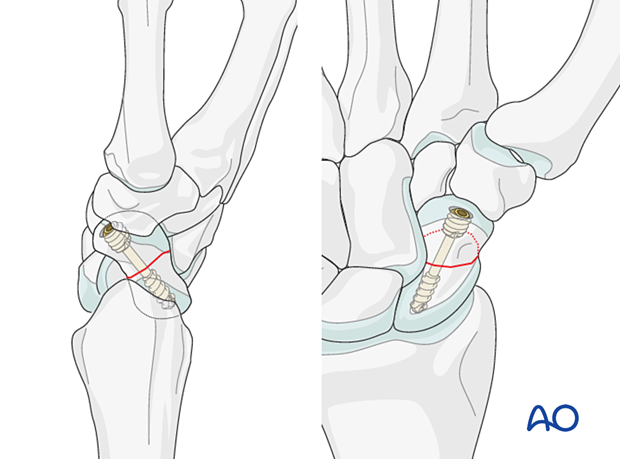 Scaphoid waist fracture - an oblique fracture in the coronal plane most often requires ORIF with either palmar or dorsal screw insertion