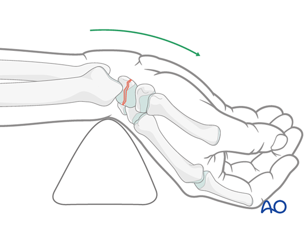 Wrist extended with the help of a towel to allow for better exposure of the scaphoid fracture