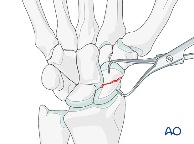 Scaphoid fracture – direct reduction