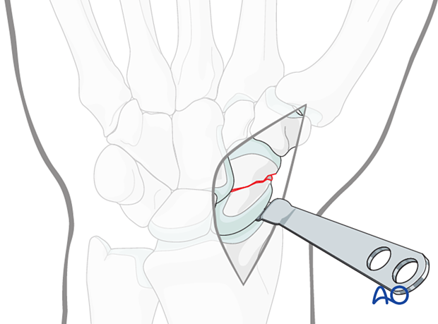 Scaphoid fracture – exposing the radial aspect of the scaphoid using a small elevator