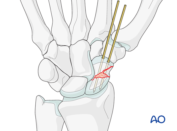 Scaphoid fracture – adding bone graft to fractures with a defect