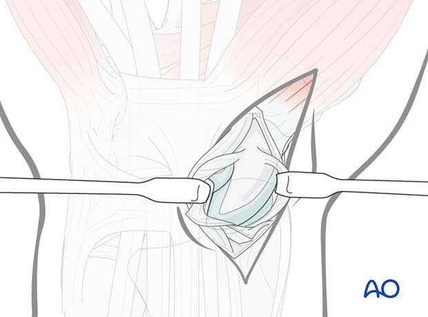 Scaphoid displaced waist fracture – identifying the fracture