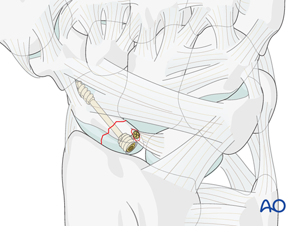 Scaphoid fracture - Scapholunate ligament reattachment