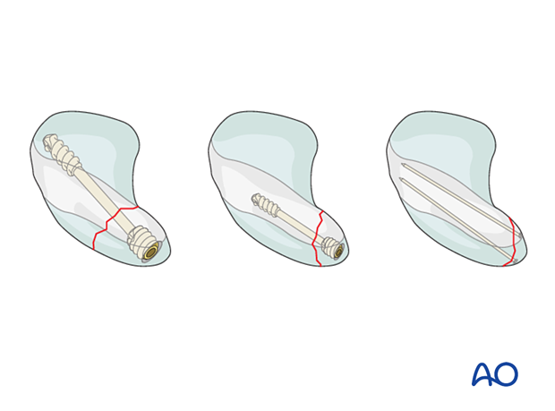 Scaphoid proximal pole fractures - choice of implant