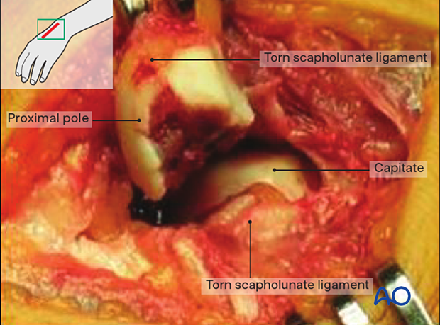 Scaphoid fracture – inspection of the fracture