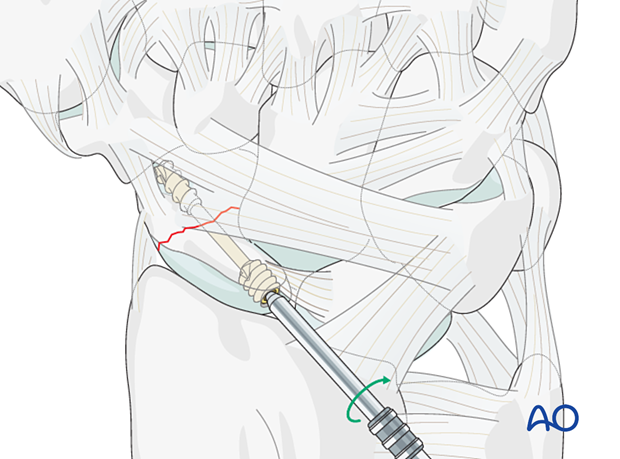 Scaphoid fracture – headless compression screw insertion