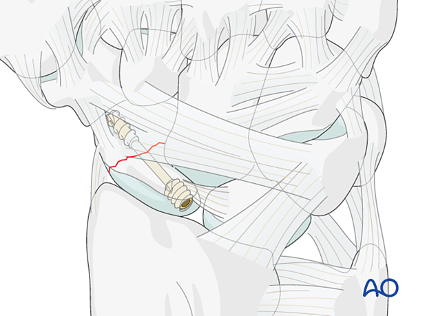 Scaphoid waist fracture – headless compression screw used in an antegrade fashion through a dorsal approach